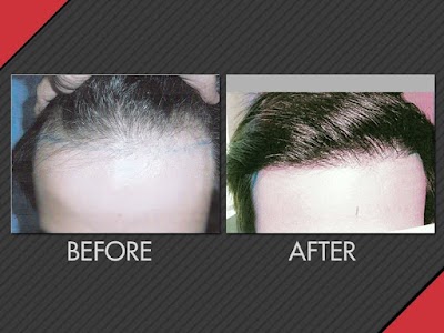 photo of MAXIM Hair Restoration