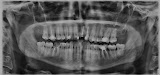 Діагностика 3D Planmeca, КТ Житомир, Незалежна щелепно-лицьова компютерна томографія, КТ зуба. Рентген зуба. КТ Зубов. Панорамный снимок зубов. 3D снимок. КТ Рентген гайморовых пазух. Панорамный снимок. ОПТГ, ТРГ, Хирургичные шаблоны