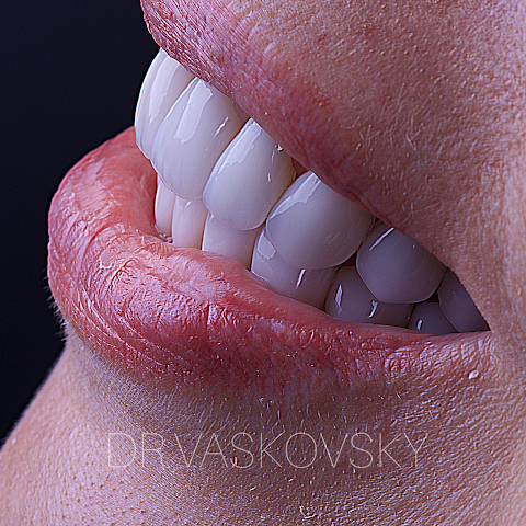 Vaskovsky Dental Clinic - Стоматология Ирпень, Виниры