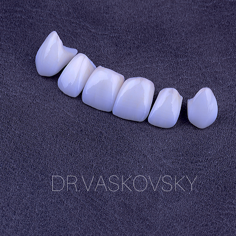 Vaskovsky Dental Clinic - Стоматология Ирпень, Виниры