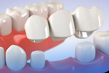 Стоматология | Dental-C | На Лесном | Протезирование зубов. Зубные коронки. Брекеты. Виниры.