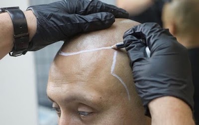 photo of SCALPS | Scalp Micropigmentation Centers