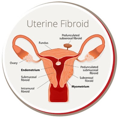 USA Fibroid Centers