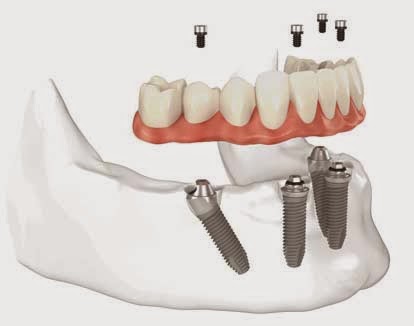 Dentista Poggibonsi - Iris Compagnia Odontoiatrica