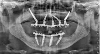 Dottor Cesare Paoleschi Firenze - Esperto Implantologia Dentale