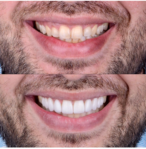 Studio Dentistico Scorca INVISALIGN | Dentista Bari | Sbiancamento | Impianti Dentali | Apparecchio Invisibile