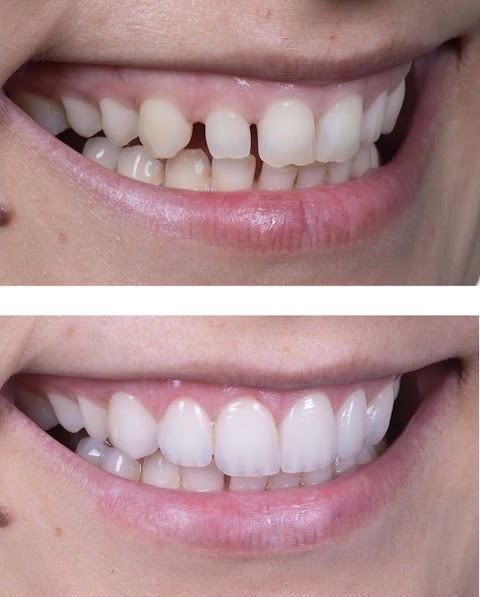 Crocetta Odontoiatria Specialistica - Invisalign Milano