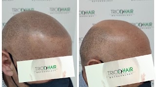 Tricohair Methodology