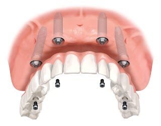 Studio dentistico dott. Emiliano Zoboli - Chirurgia orale,implantologia ad alta specializzazione