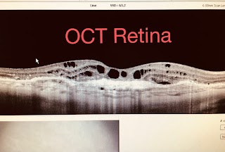 Oculista Petti #cataratta #Laser