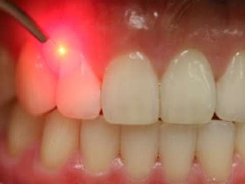 Laserterapia assistita Milano - Trattamenti odontoiatrici