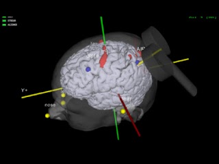 Brain Institute TMS - Centro di Stimolazione Magnetica Transcranica