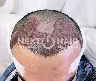 Next Hair - Trapianto di capelli