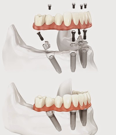 Dentista San Giovanni Valdarno - Iris Compagnia Odontoiatrica (Dr. Cesare Paoleschi)