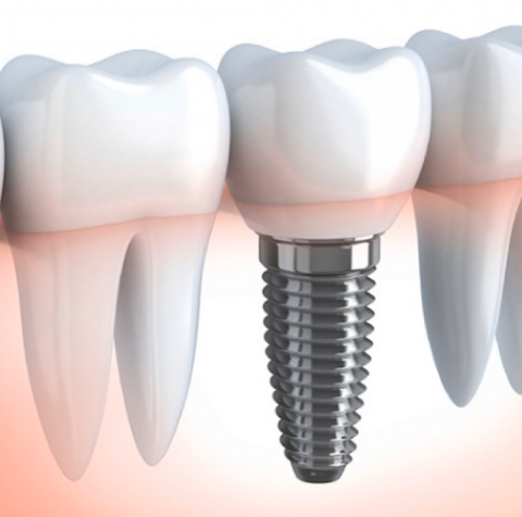 Studio Dentistico Scorca INVISALIGN | Dentista Bari | Sbiancamento | Impianti Dentali | Apparecchio Invisibile