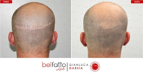 Gianluca Garsia: Tricopigmentazione Roma e tatuaggio capelli