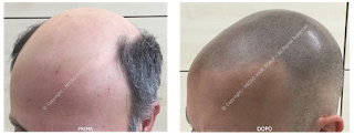 Micro Hair Scalp Tricopigmentazione Permanente Sicilia