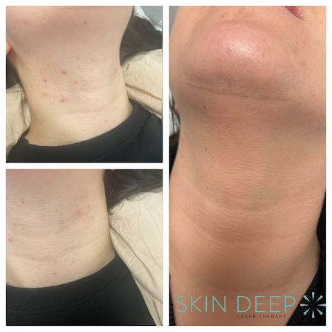 Skin Deep Laser Therapy Tamworth