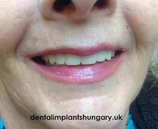 Dental Implants Hungary