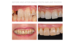 Rob Pittack Dental Implants Mill Hill