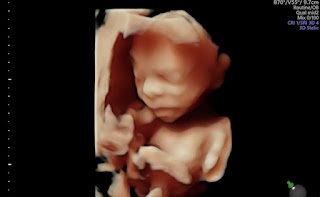 Numi Scan North London - Baby Scan - Vascular