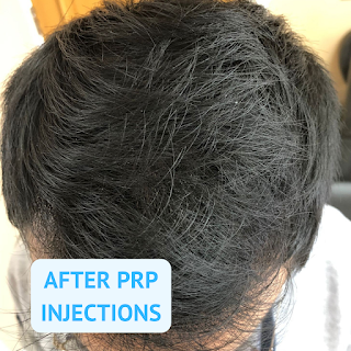 Hair Loss Studio | Hair Transplants | PRP | SMP