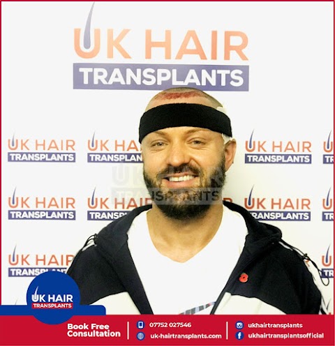 UK Hair Transplants UKHT Hair Loss Clinic - Birmingham - Walsall - Leicester - West Midlands