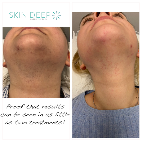 Skin Deep Laser Therapy Tamworth