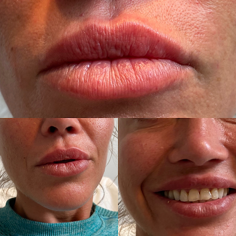 Perfect Aesthetics | Advanced Botox & Lip Fillers Plymouth