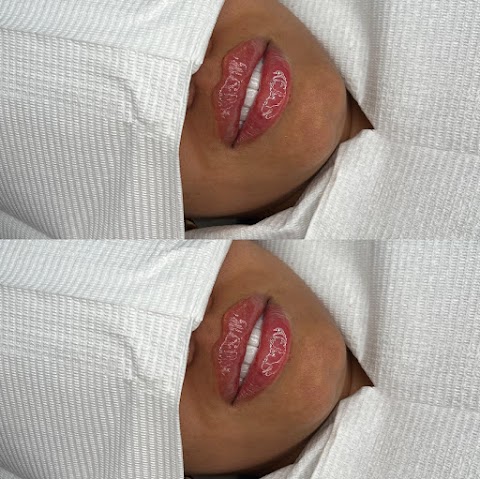 Elm Aesthetics lip fillers and wrinkle relaxation Leeds