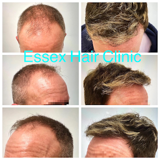 Essex Hair Clinic