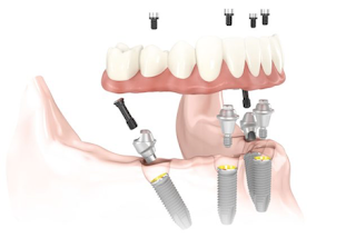 Active Dental Denture Clinic