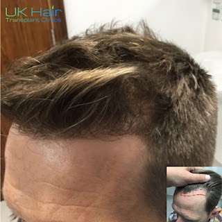 UK Hair Transplant Clinics