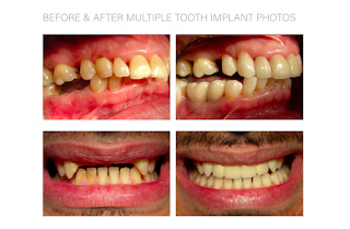 Rob Pittack Dental Implants Mill Hill