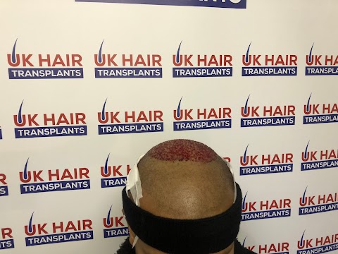 UK Hair Transplants UKHT Hair Loss Clinic - Birmingham - Walsall - Leicester - West Midlands