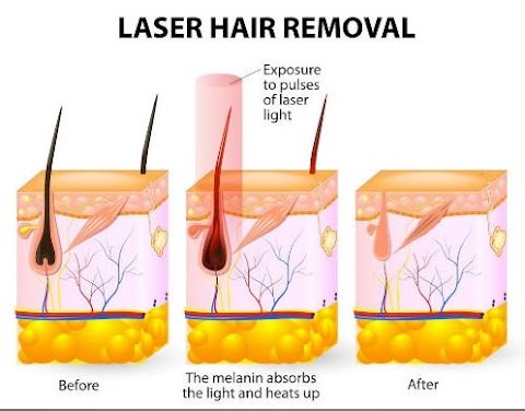 Yorkshire Laser Teeth Whitening, Hair Removal & IPL, Laser Tattoo Removal