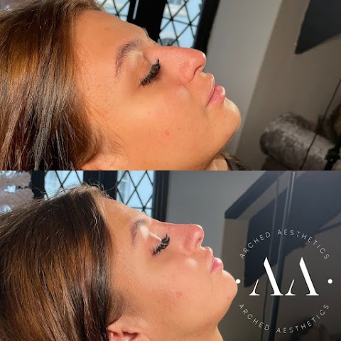 Arched Aesthetics | Aesthetic Treatments & Lip Fillers Plymouth