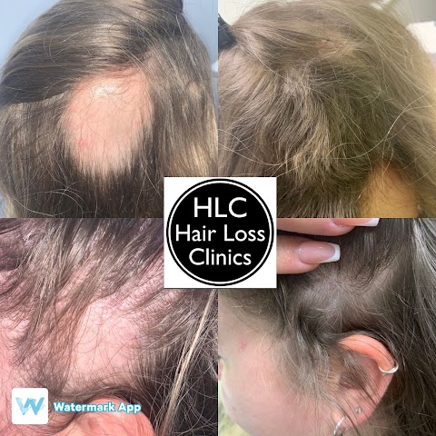 Leicester Hair Loss Clinic