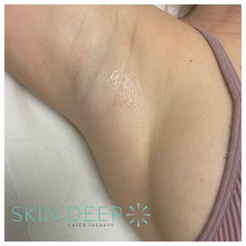 Skin Deep Laser Therapy Tamworth