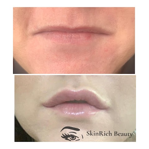 SkinRich Beauty - Lip Fillers - Anti Wrinkle Treatments - Dermaplaning - Fat Dissolving Injections - Microneedeling