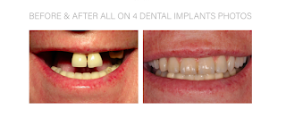 Rob Pittack Dental Implants Mill Hill