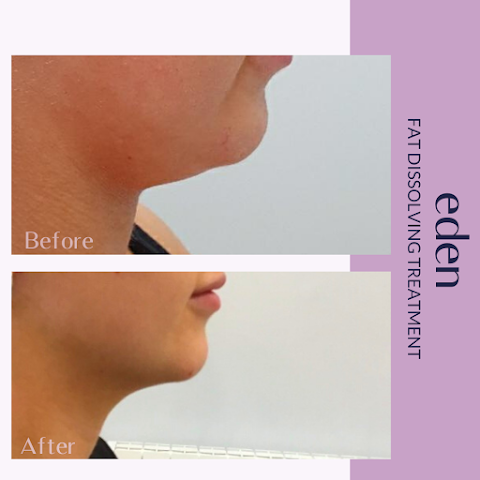 Eden Medical Belfast - Dermal filler, Anti wrinkle, Lip filler, Cheek, Jawline, Belfast