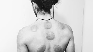 Mubarak Cupping Therapy