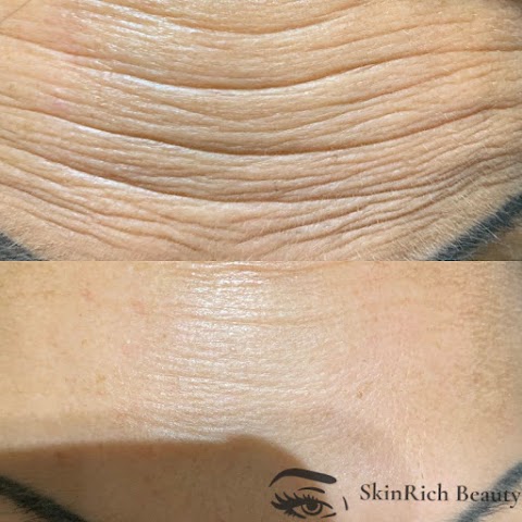SkinRich Beauty - Lip Fillers - Anti Wrinkle Treatments - Dermaplaning - Fat Dissolving Injections - Microneedeling