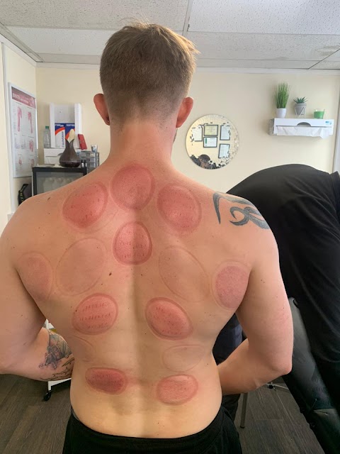 Birmingham Cupping Clinic - HIJAMA