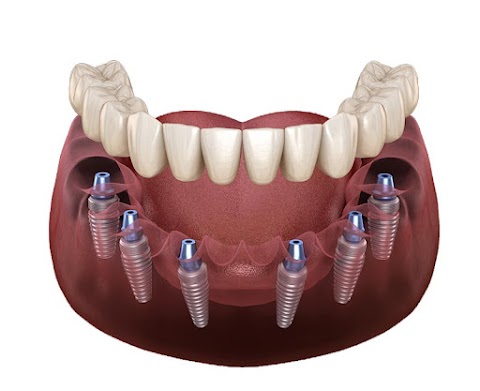 Chat Dental in Turkey