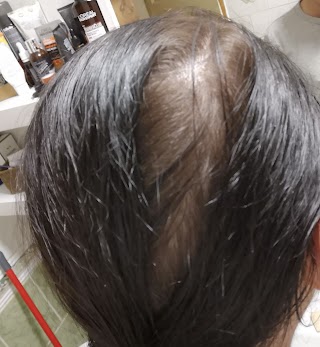 Warrington Hair Loss Clinic