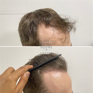 The Treatment Rooms London- Hair Transplant Clinic