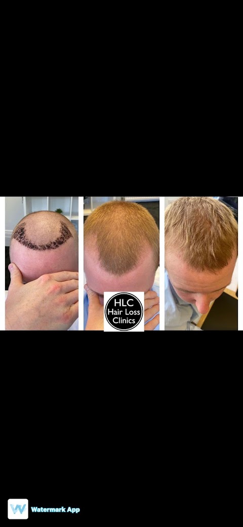 Leeds Hair Loss Clinic