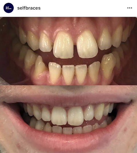 Self Braces